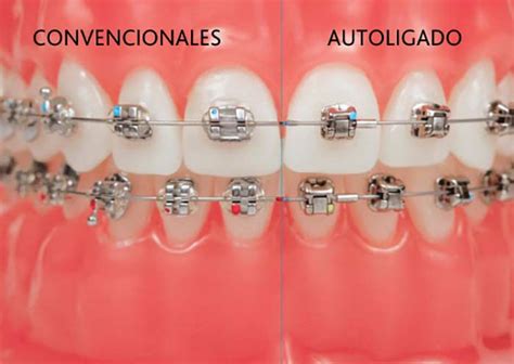 diferencia entre brackets metalicos y autoligables|diferencia entre bracketes y autoligados.